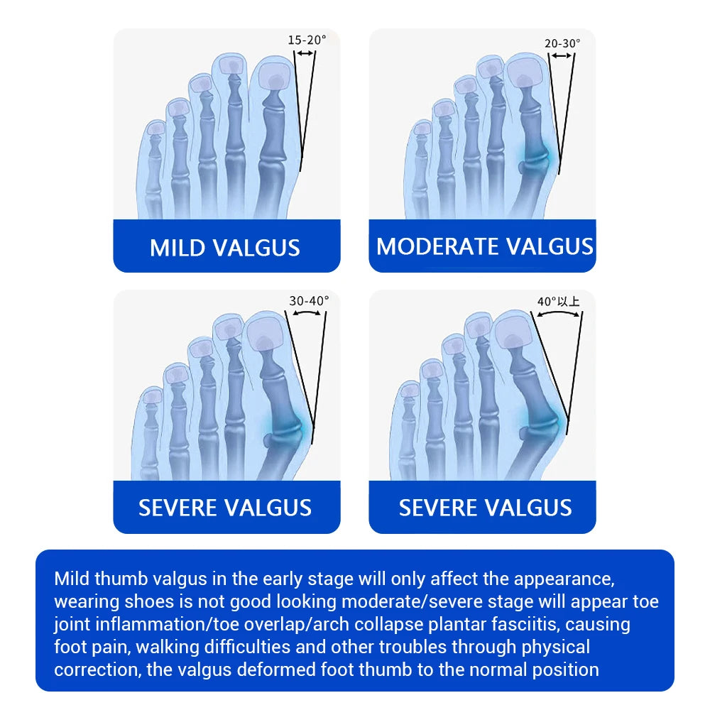 Adjustable Toe Separator & Bunion Splint – Rotatable